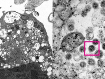Παραλλαγή Όμικρον – Η εικόνα της μέσα από ηλεκτρονικό μικροσκόπιο
