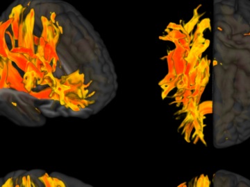 Ερευνητές εντόπισαν περιοχές του εγκεφάλου που επηρεάζονται από την υψηλή πίεση και σχετίζονται με την άνοια